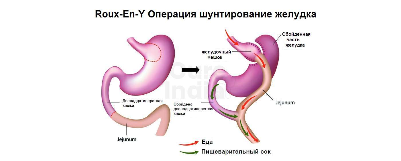 Желудочный Обход